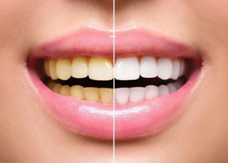 Smile Stain Remover